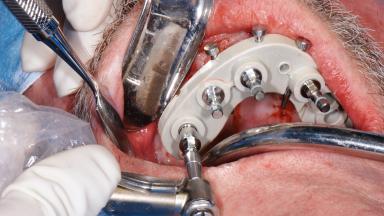 Immediate Loading of Six Implants in the Mandible and Six Implants in ...