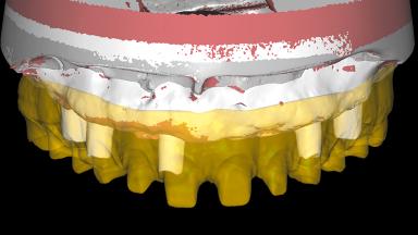 Complete Prosthetic Rehabilitation in a Fully Edentulous Patient ...