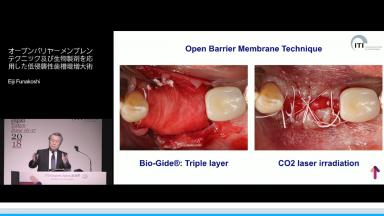 オープンバリヤーメンブレンテクニック及び生物製剤を応用した低侵襲性